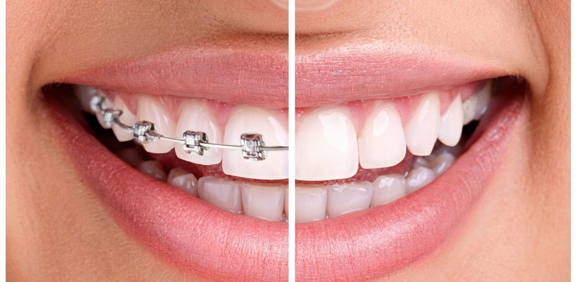 Fases del tratamiento de ortodoncia y duración