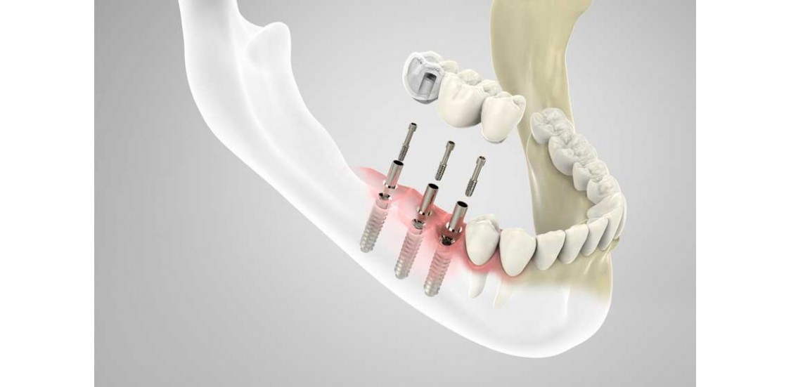 ¿Qué es un implante dental y cuáles son los más recomendables?