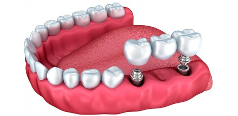 Implantes para combatir la pérdida de hueso maxilar