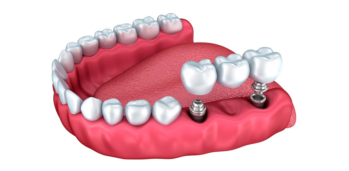 Implantes para combatir la pérdida de hueso maxilar